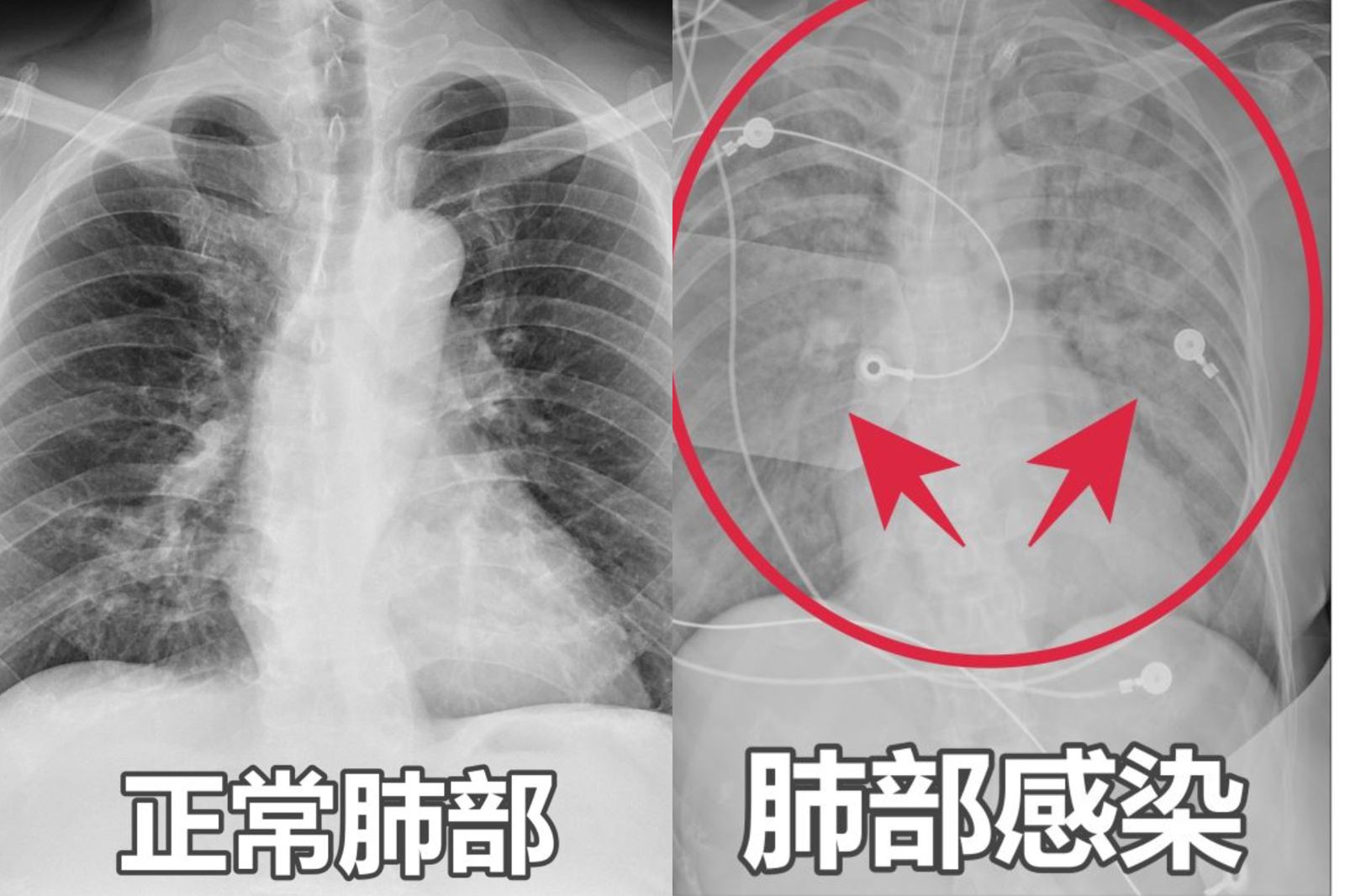 65歲婦嗜睡、胃口差…如靈魂出竅！X光一照竟「雙肺全白」