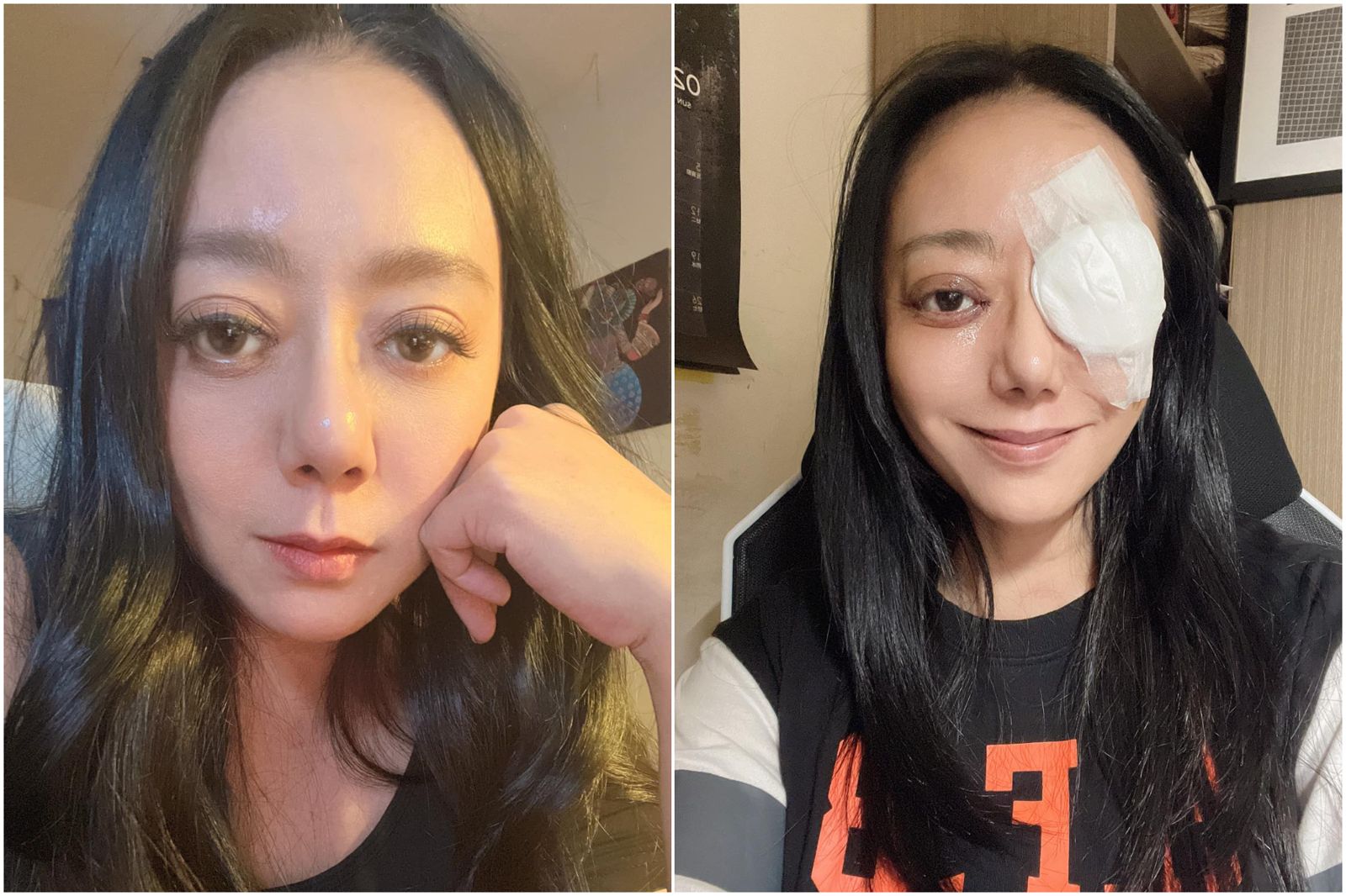 53歲金鐘視后一個月動3次手術!全身麻醉、削骨 做好恐失明最壞打算