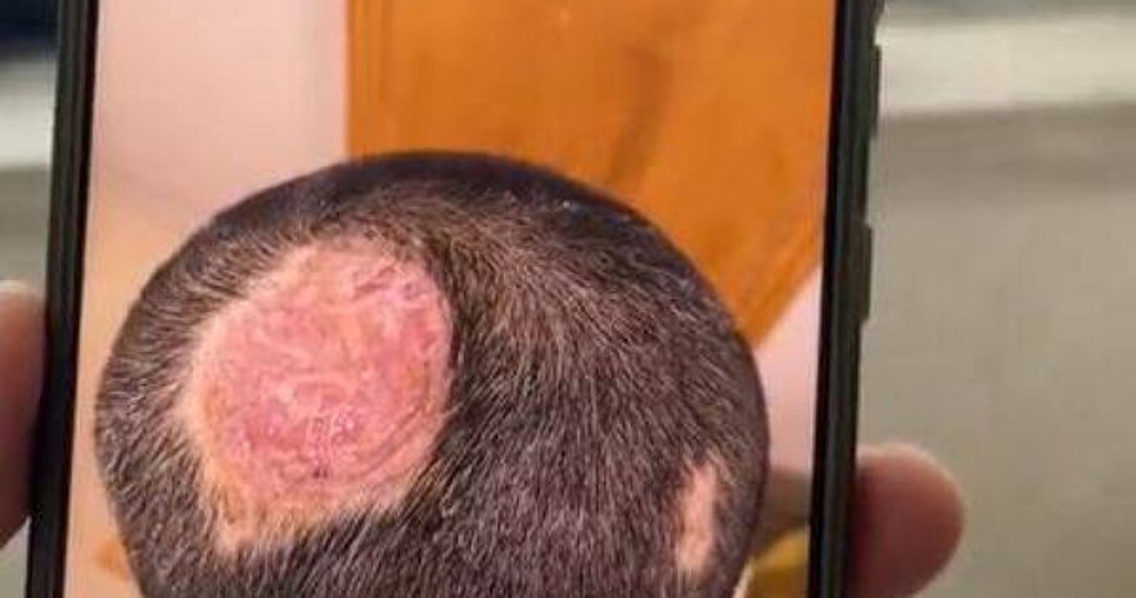 6歲男童無預警掉髮、頭皮一片紅！竟是「1寵物」釀禍…醫警告：恐永久禿頭