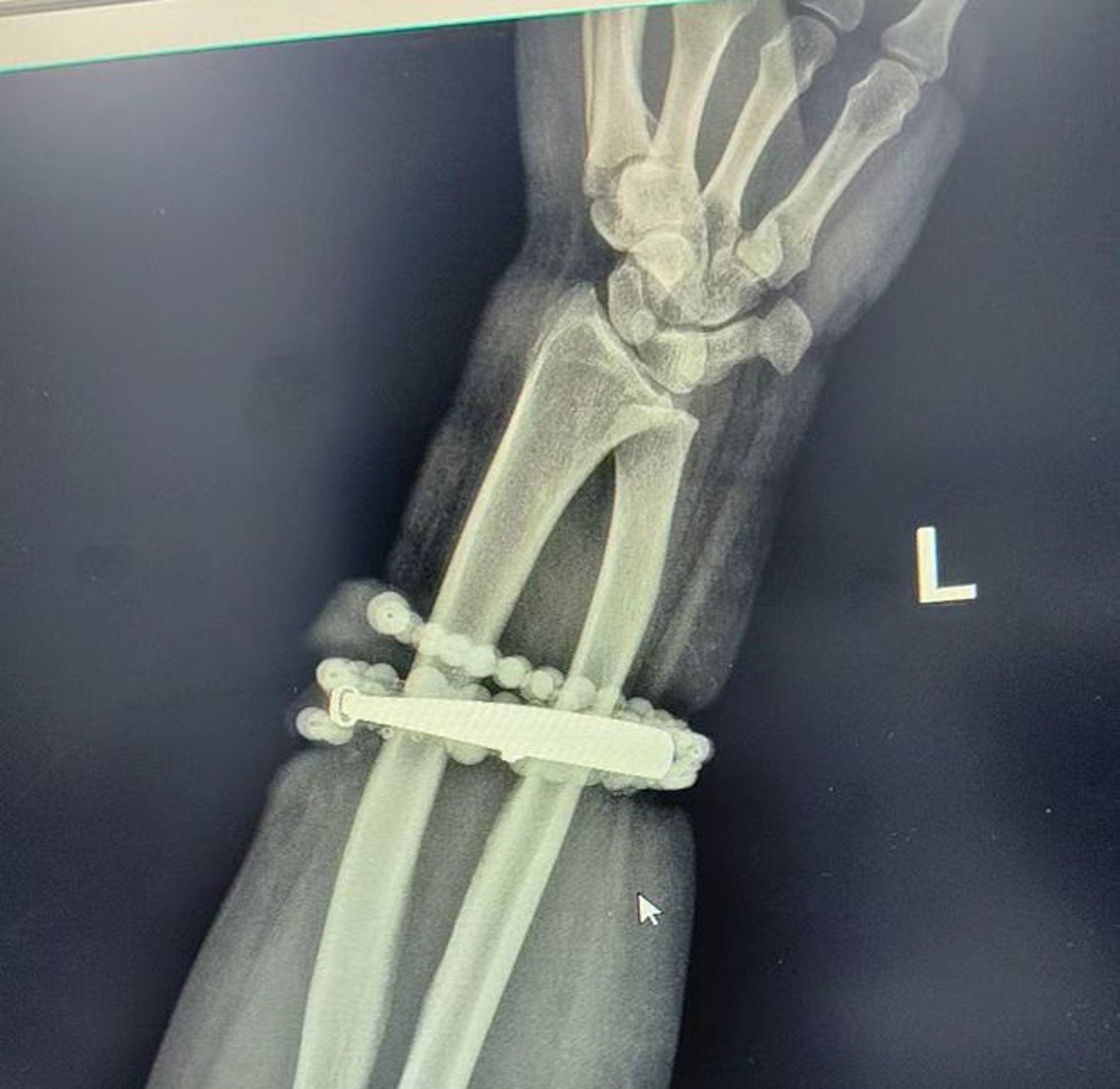 婦人的手鐲和串珠嵌入手腕。圖／翻攝自微博