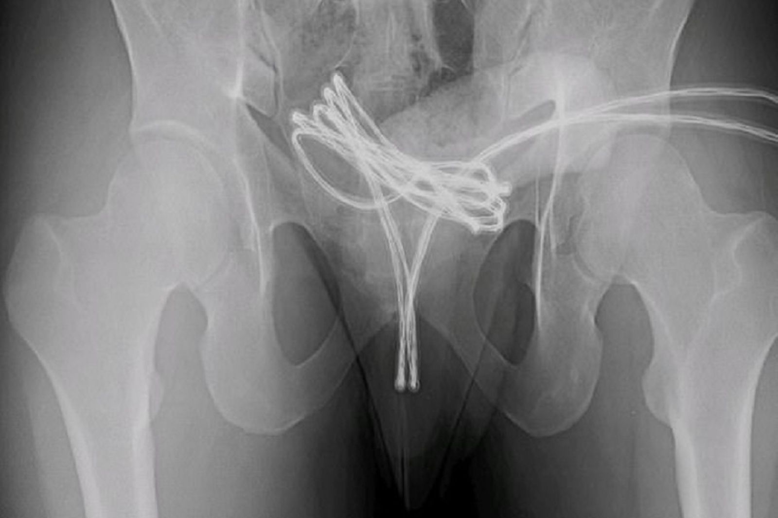 與USB線刺激愛愛 整條卡進下體突破膀胱!尷尬影像曝光