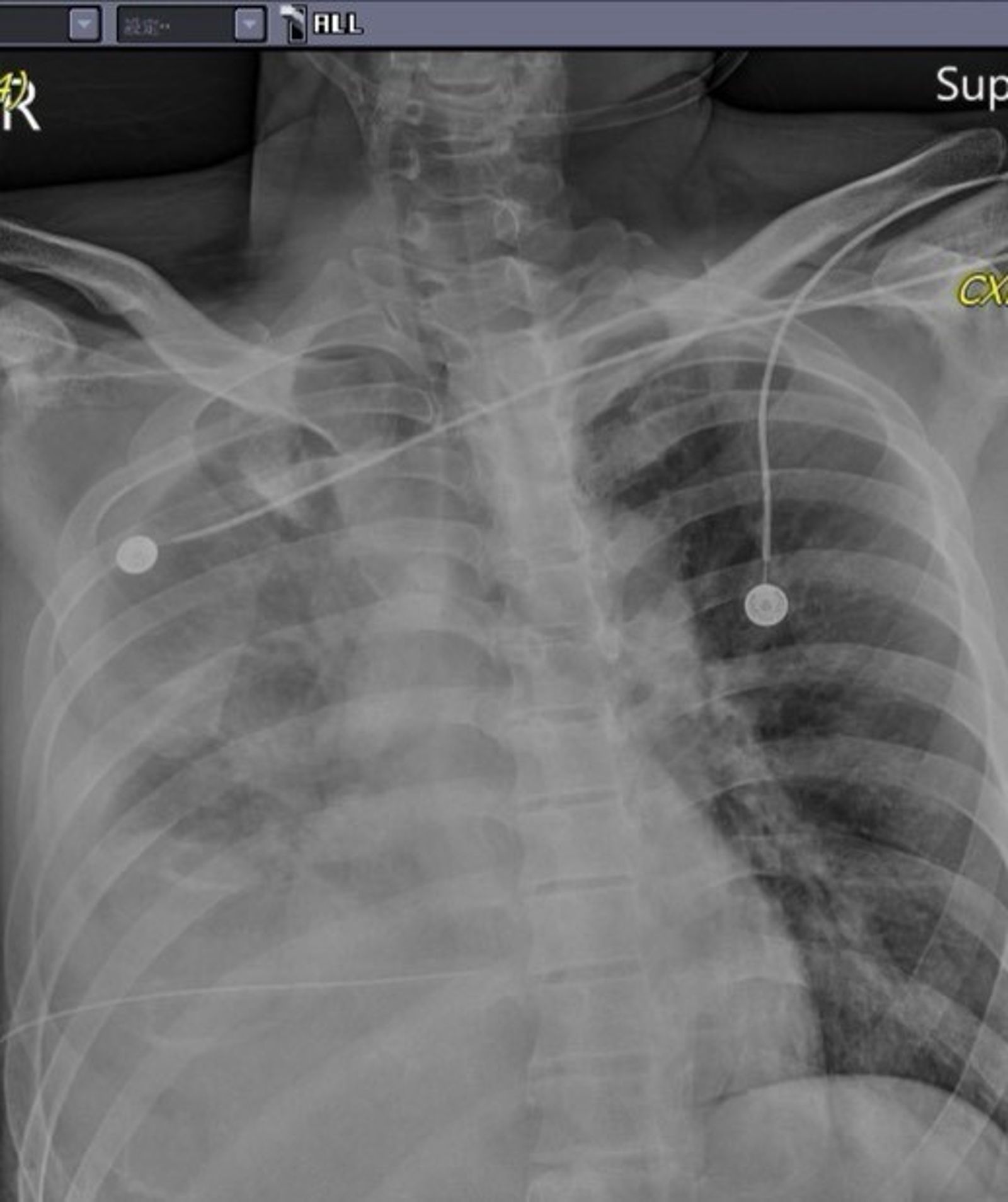 林姓被害人氣血胸、橫膈膜及肝臟破裂及大量出血。圖/翻攝自馮啟彥臉書
