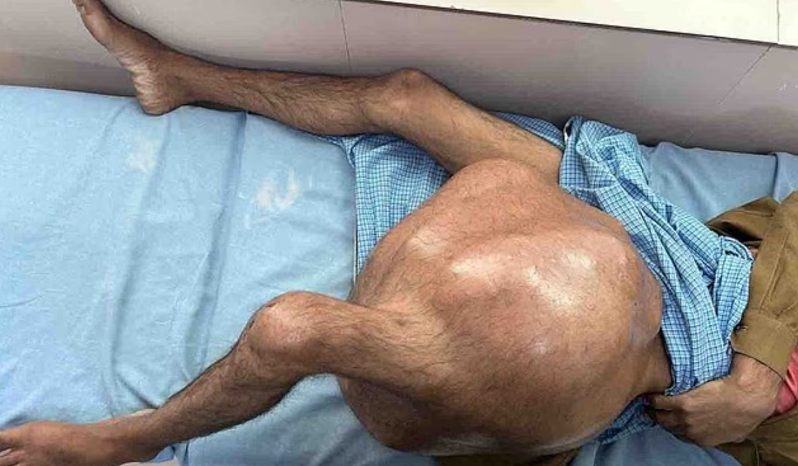 大腿腫瘤「比8歲小孩還重」！27歲男「沒醫院收治」臥床半年…醫師冒險開刀救命