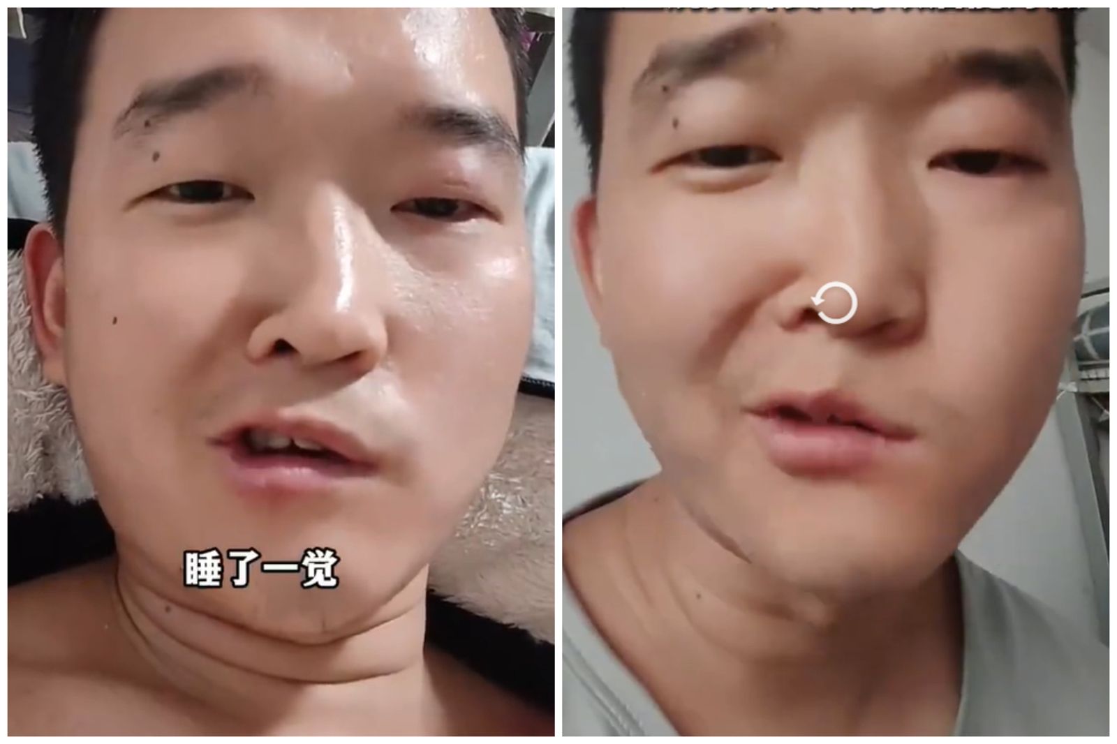 天氣太熱！男子睡覺「做這件事」　起床竟然中風了…整臉歪掉