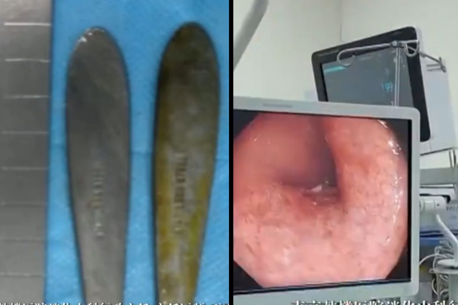 28歲男腹痛求診　醫一看大驚：腸道卡著2支「12公分長湯匙」