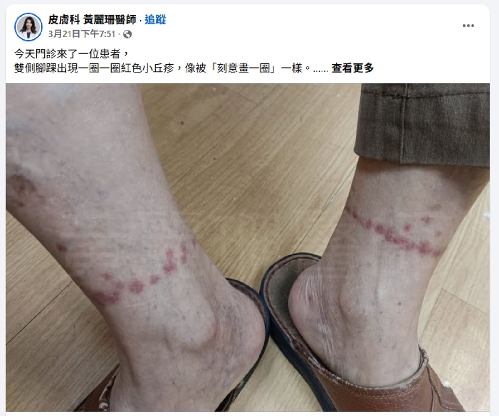 患者雙腳腳踝分別出現一圈紅疹。圖／皮膚科 黃麗珊醫師FB