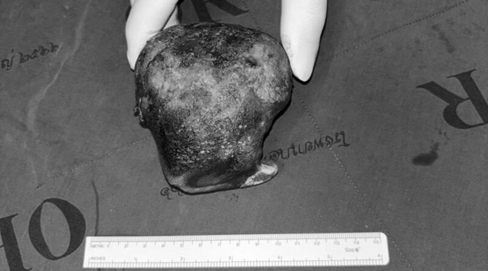 肚子痛竟是愛情咒語害的!她開刀驚見「12cm神祕巨石」 敲開流惡臭泥水、11顆彩珠...真相超毛