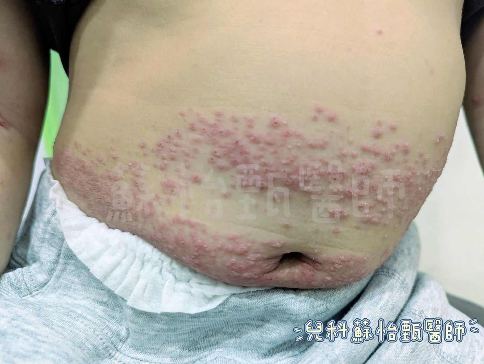 兒科醫師蘇怡甄近日分享一名令她印象深刻的4歲男童個案,「整片粉紅水泡」讓她也驚呆。圖/翻攝自「兒科蘇怡甄醫師」臉書
