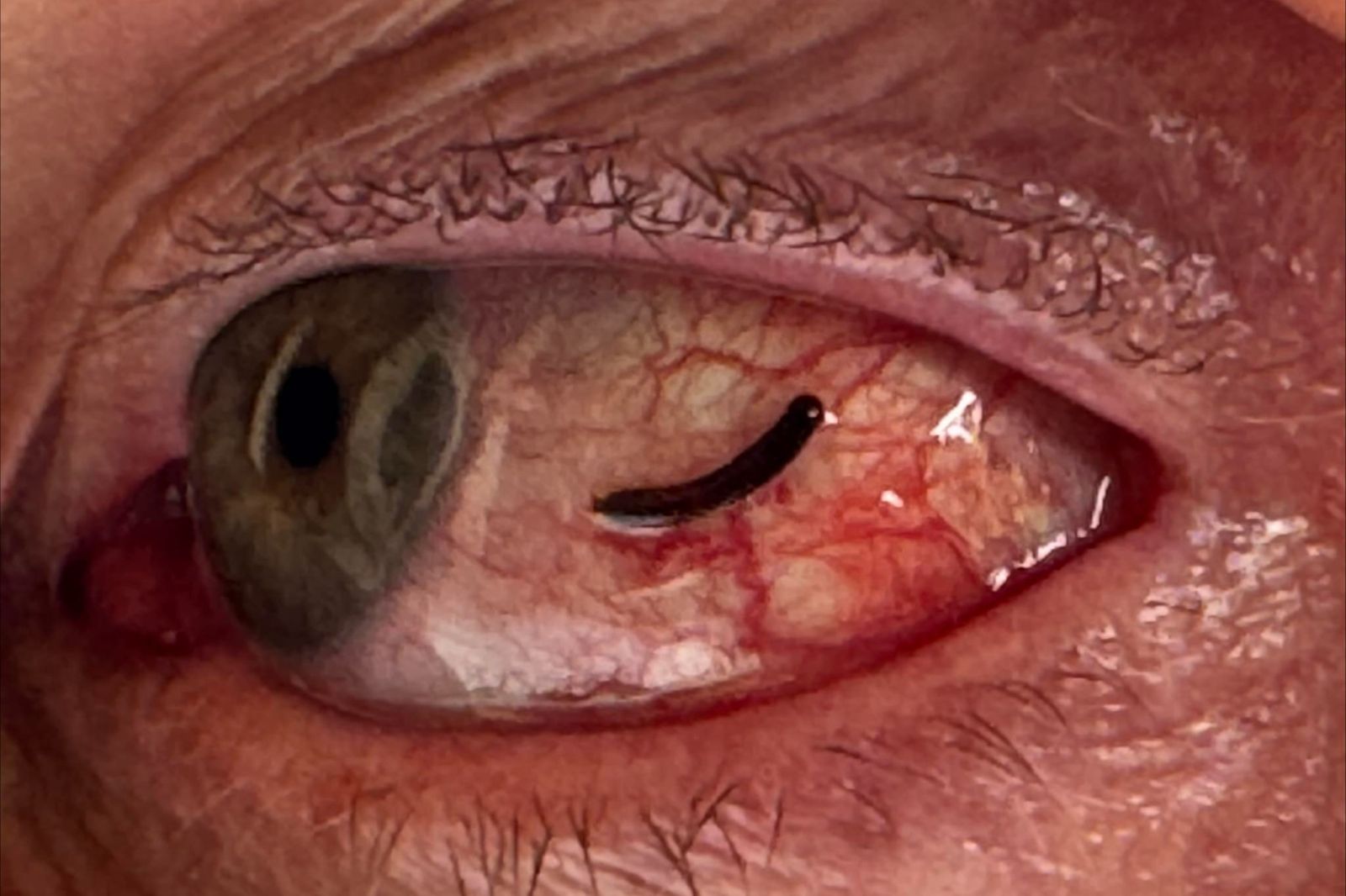 英國一名58歲男子眼球被水蛭吸附6個小時。圖／翻攝自Tony Exall臉書