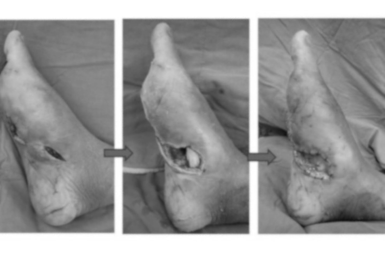 小傷口不在意！50歲男腳傷潰爛險截肢　醫提醒：紅腫熱痛要盡快就醫