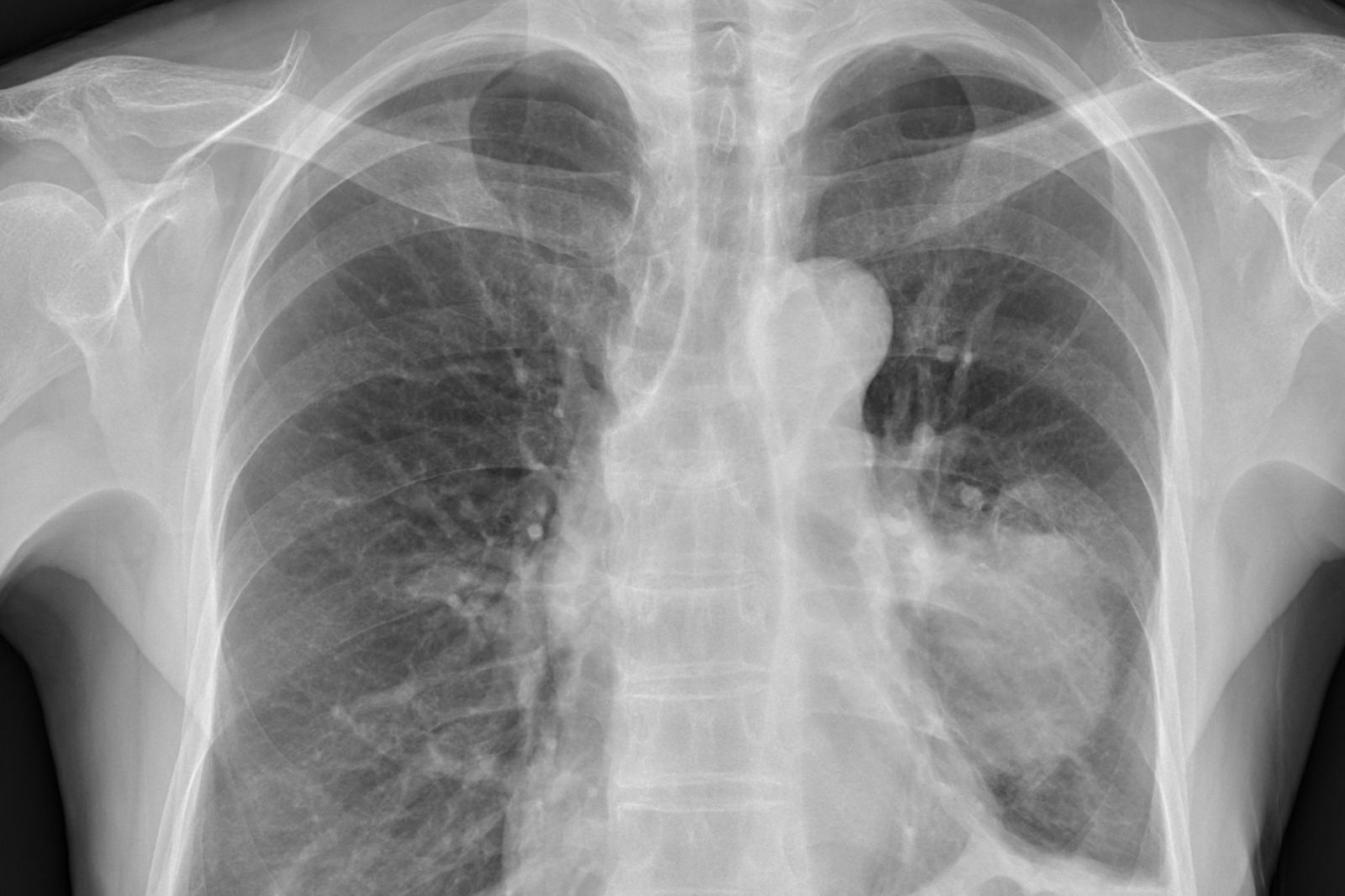 60歲婦1症狀拖3個月！醫檢查驚「腫瘤8公分大」：已經癌末