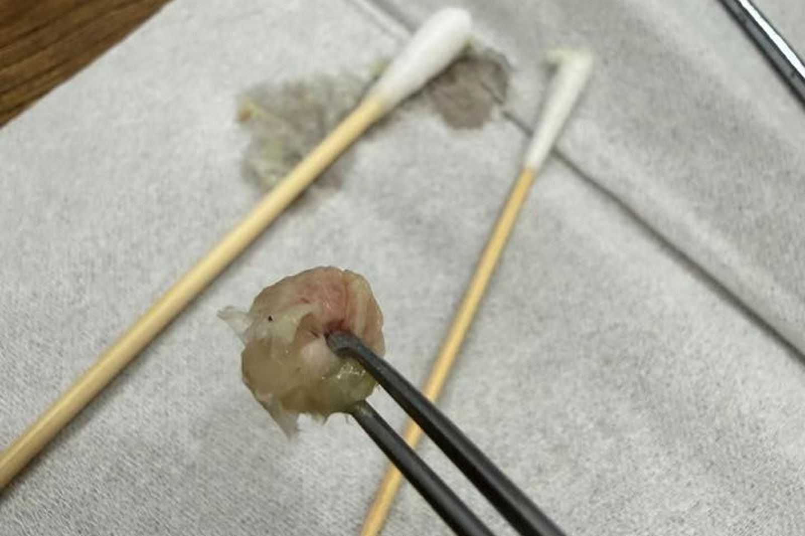 孩子鼻塞就醫,竟塞著一球衛生紙。圖/翻攝自郭子龍醫師臉書粉專