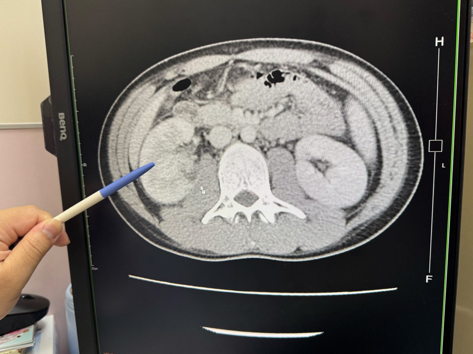 23歲男突昏迷＋敗血症！竟因每天喝「這東西」導致　