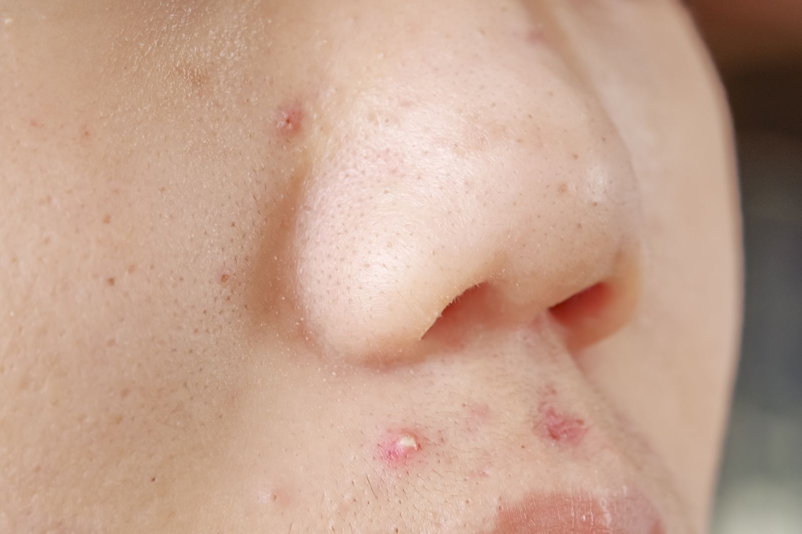 只擠了一顆痘痘…女大生幾天後感染身亡！醫警告：臉上「死亡三角」別亂擠