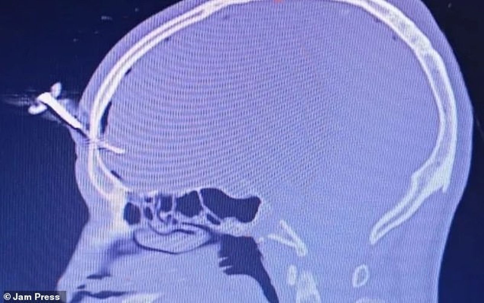 史密斯的額頭被插車鑰匙，之後透過手術取出。圖／翻自《每日郵報》