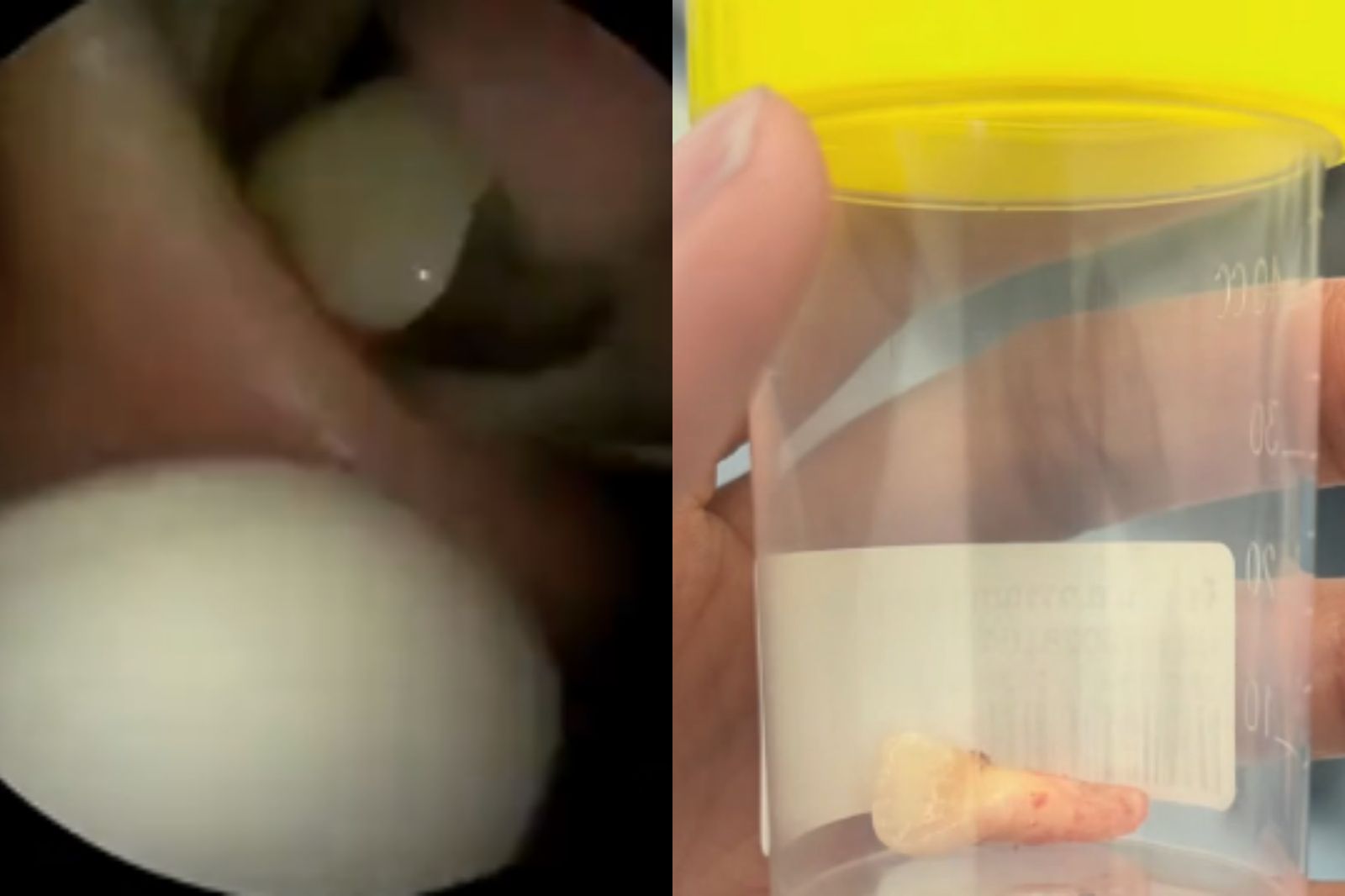 長期呼吸困難!女子照X光發現「鼻子長牙齒」...連醫師也看傻