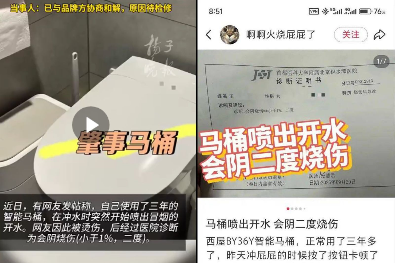 女子會陰嚴重燙傷「全變白」！兇手竟是家中免治馬桶