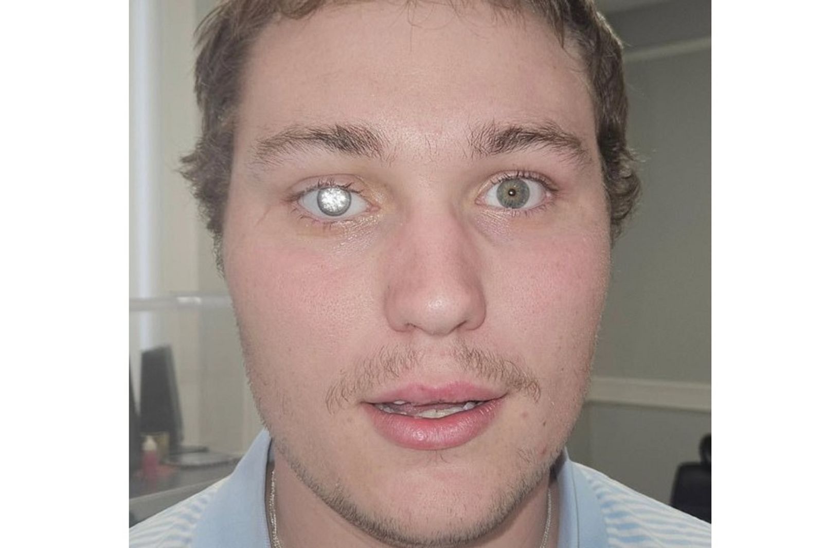 狂！他把2克拉鑽石鑲進「眼球」　網驚：很怕你被活摘器官