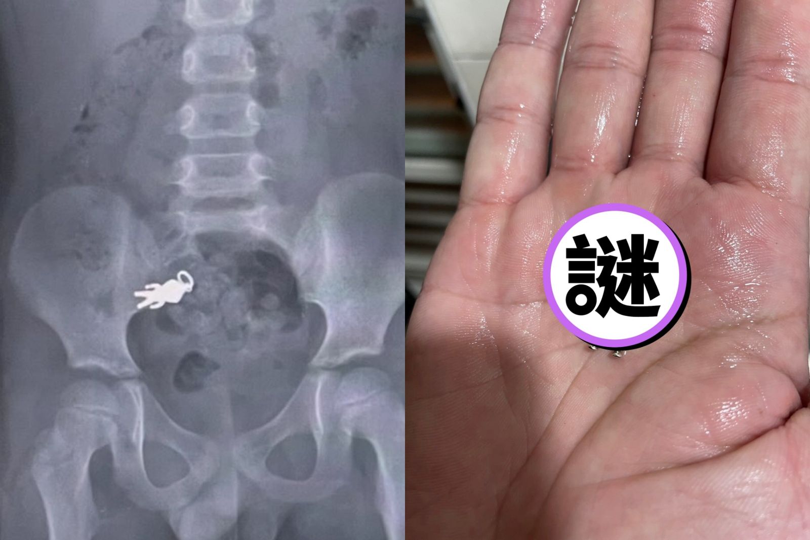 警惕！童看電視誤吞公仔　超人力霸王「奧特曼」5天後回歸照曝
