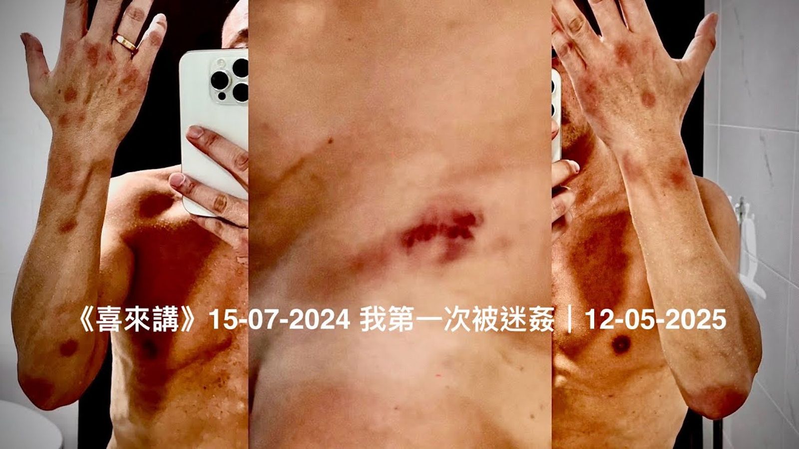 王喜展示自己身上傷痕。翻攝喜來大DD