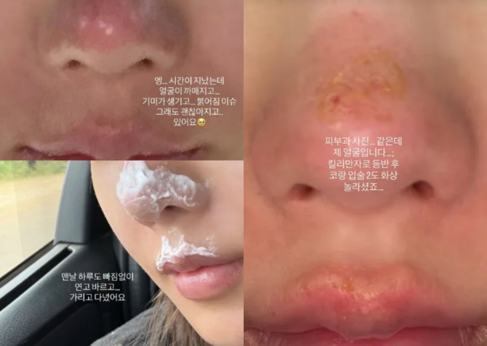 權恩妃曝光傷照。翻攝＠silver_rain.__