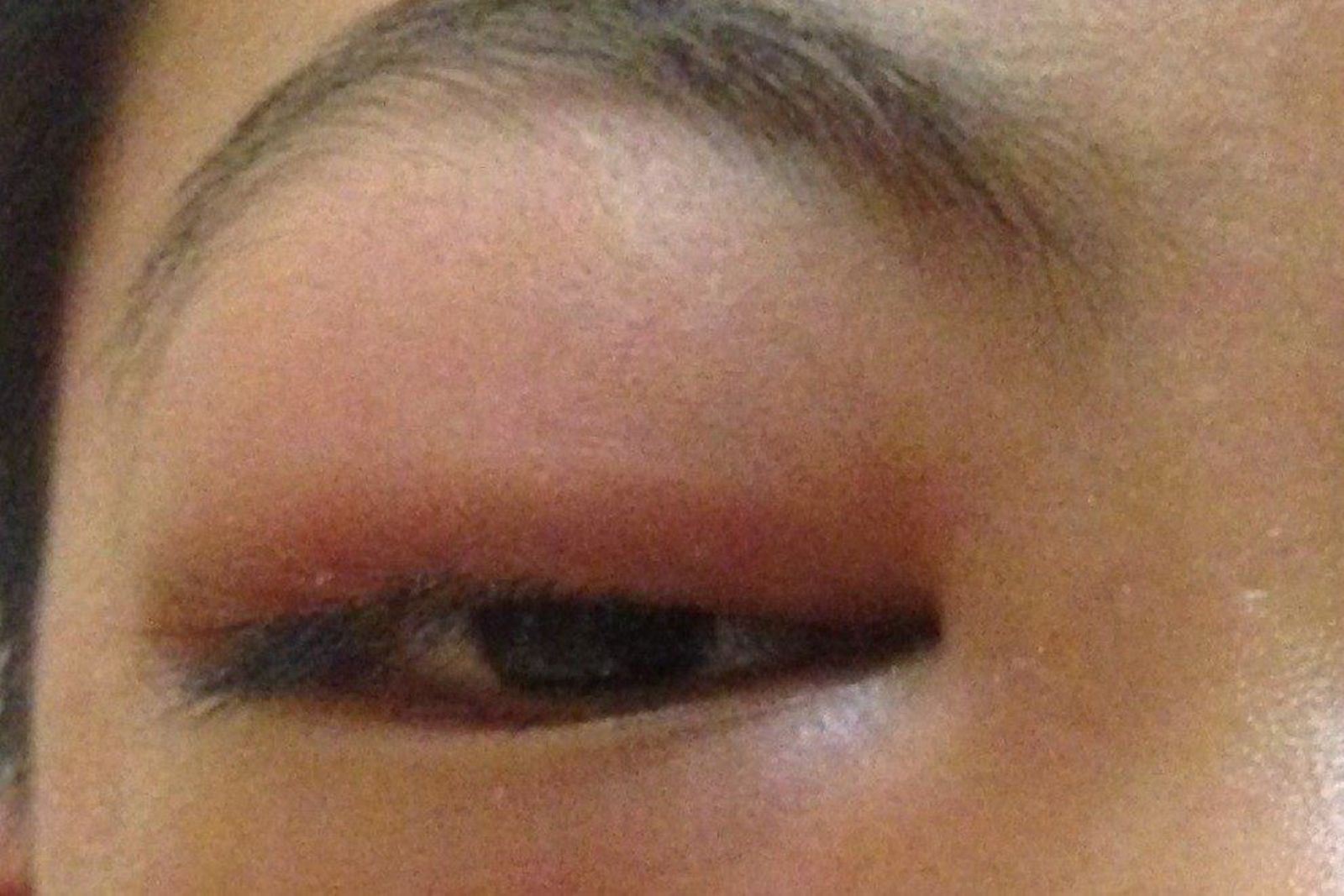 換季鼻塞拖成大病！13歲童眼窩蜂窩性組織炎險失明