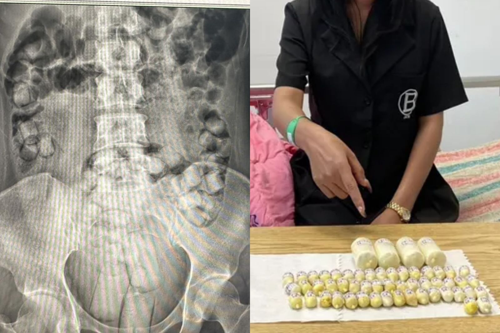 2泰女「肛門塞毒」闖台遭攔查！花10小時排出上百顆海洛因