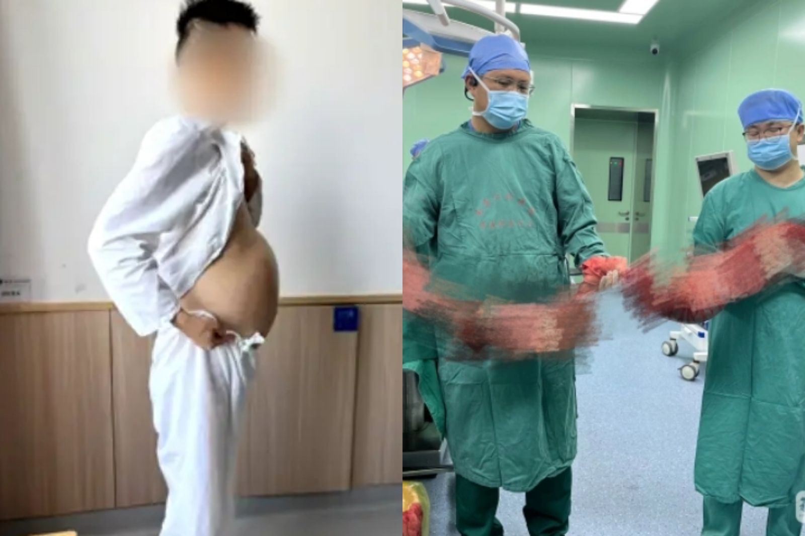 男便秘4個月!肚子大到像懷孕 開刀取出「2公尺巨蟒結腸」