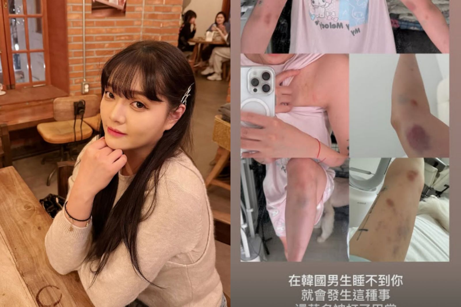 旅韓YTR劉力穎「拒絕韓男搭訕」遭痛毆骨折　外交部發聲了