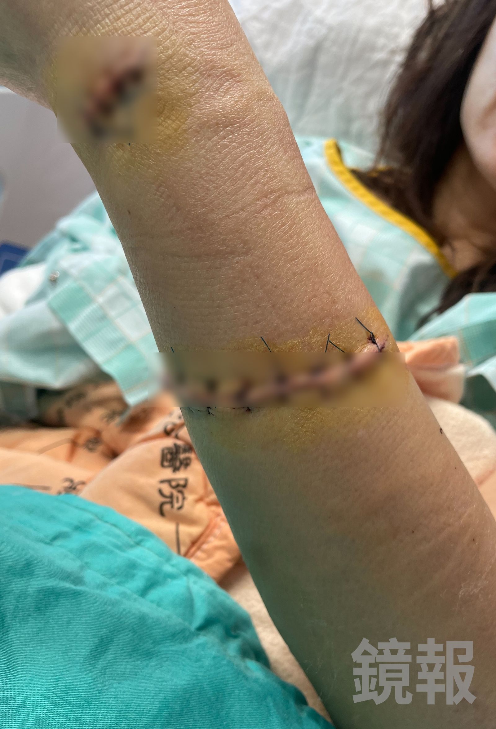 被害人雙手幾乎被砍廢。