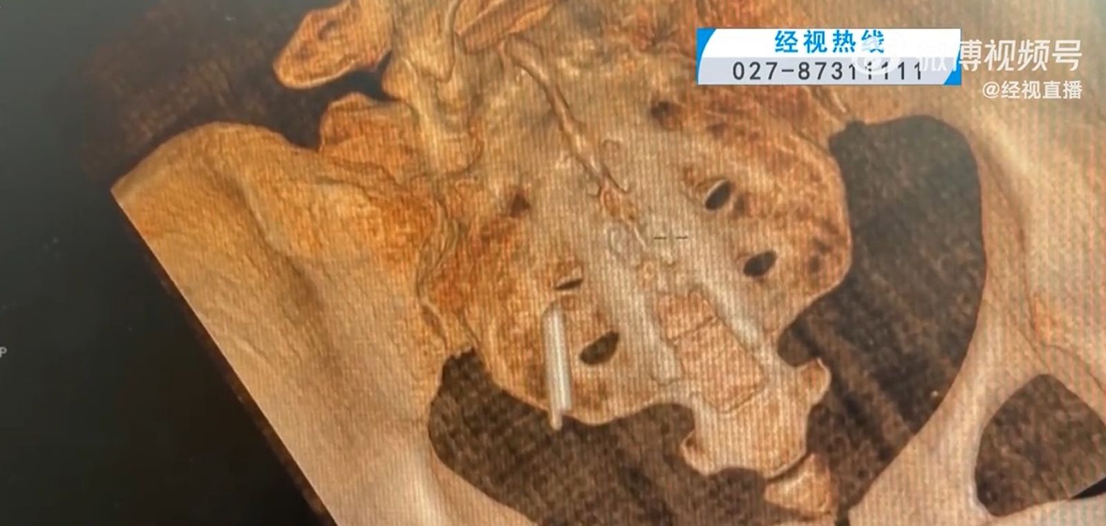胡女體內藏了22年的體溫計，如今終於成功取出。圖／翻攝自微博／經視直播