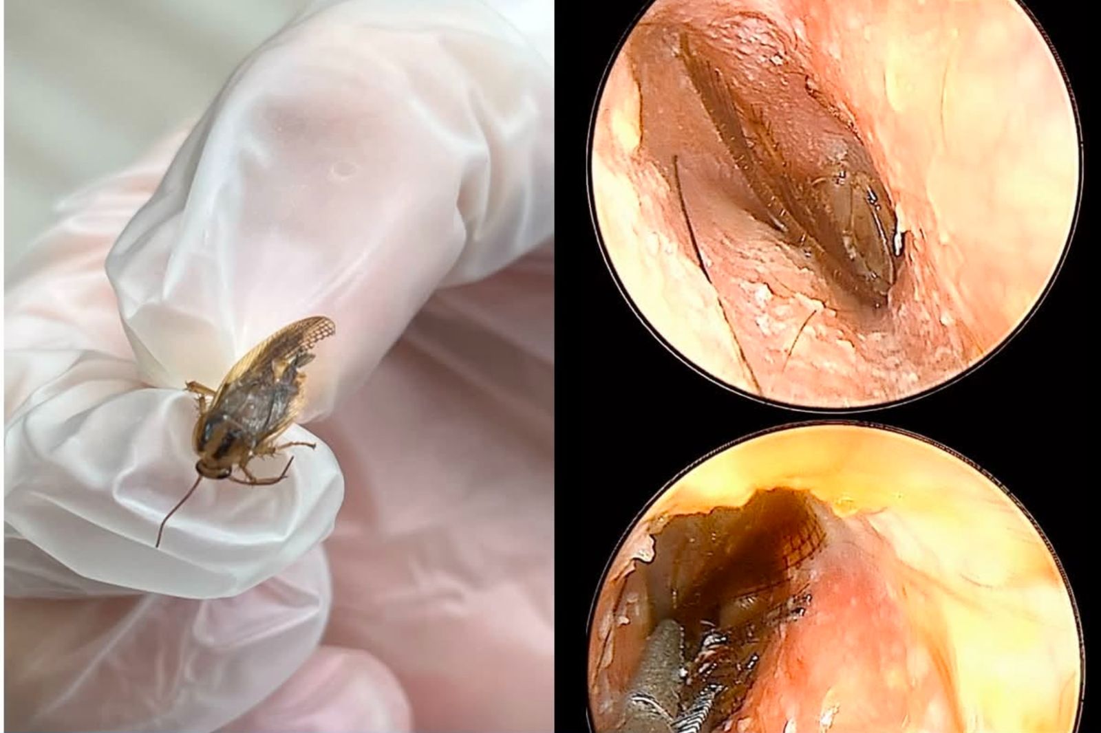 他喊「耳裡有蟑螂」遭疑幻想!醫一照驚見腿毛卡深處 病患吐1句全場靜默
