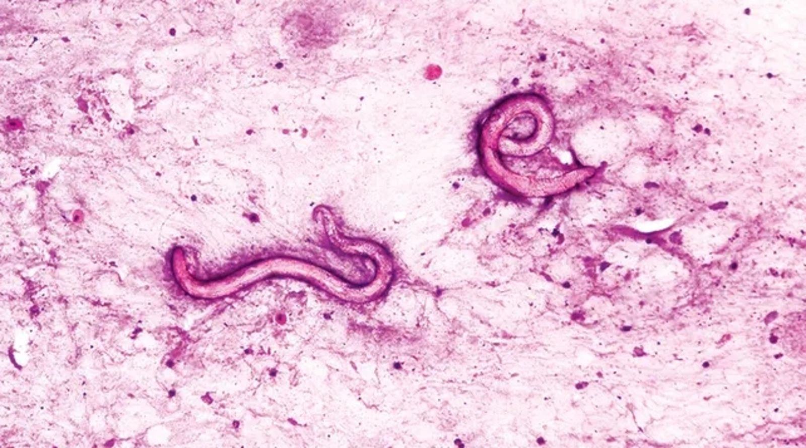 腎臟移植後休克再送醫！61歲男「體內都是寄生蟲」畫面曝…竟是捐贈者「少做1事」