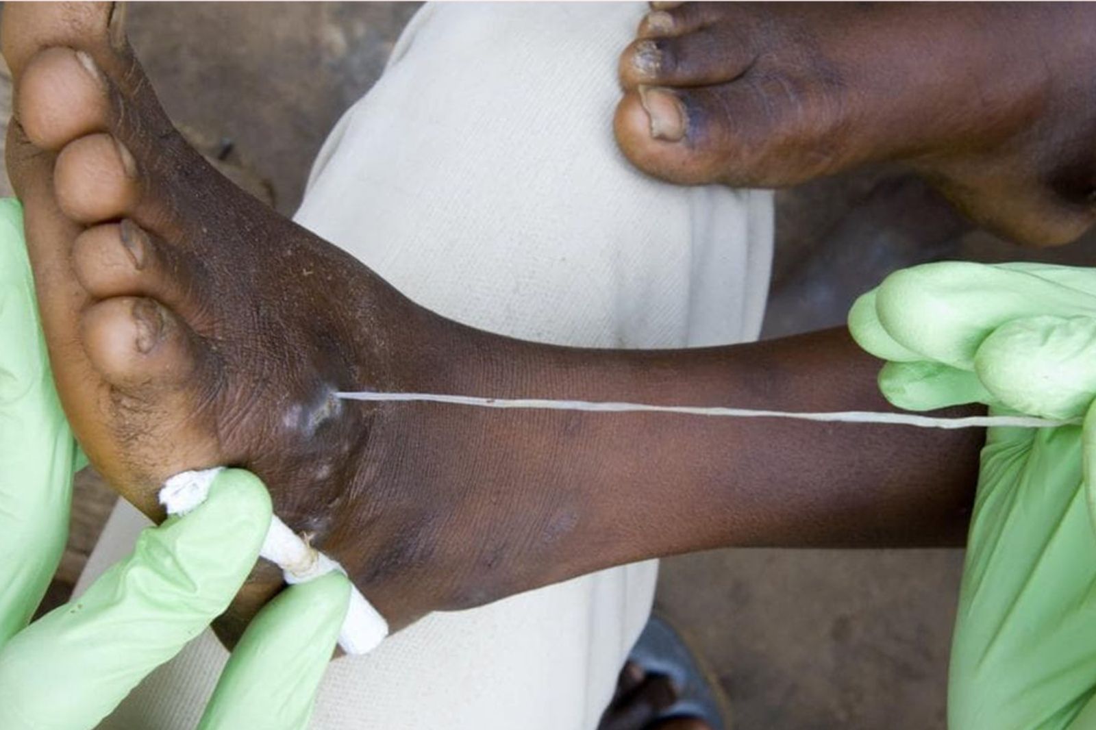 比滿清10大酷刑痛！1公尺長蟲「肉中抽絲」花數週　纏鬥3500年、沒疫苗竟快滅絕了