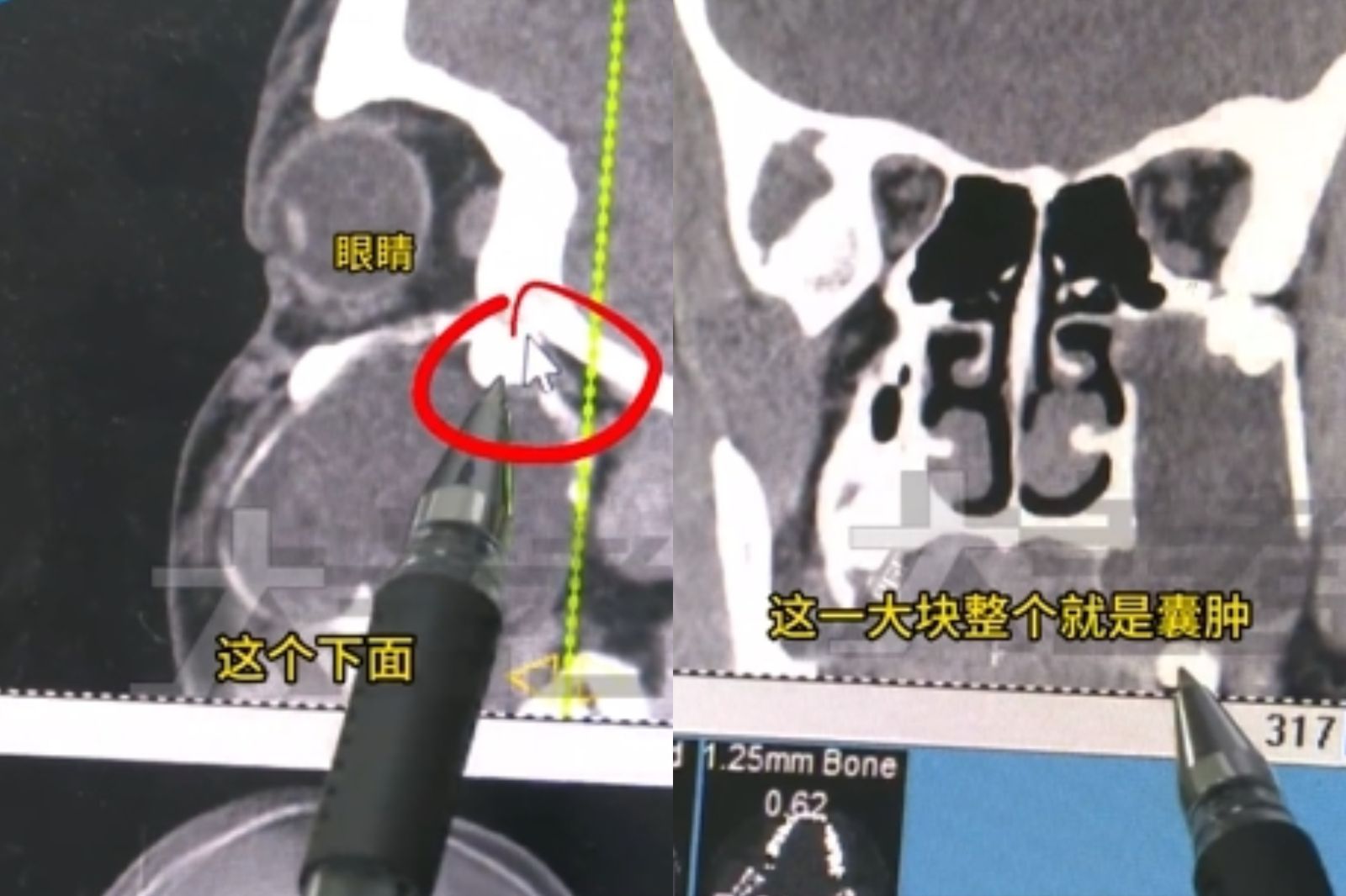 15歲兒臉腫嘴歪！媽以為發福　醫照X光嚇傻：竟是「這裡」異常發育害的
