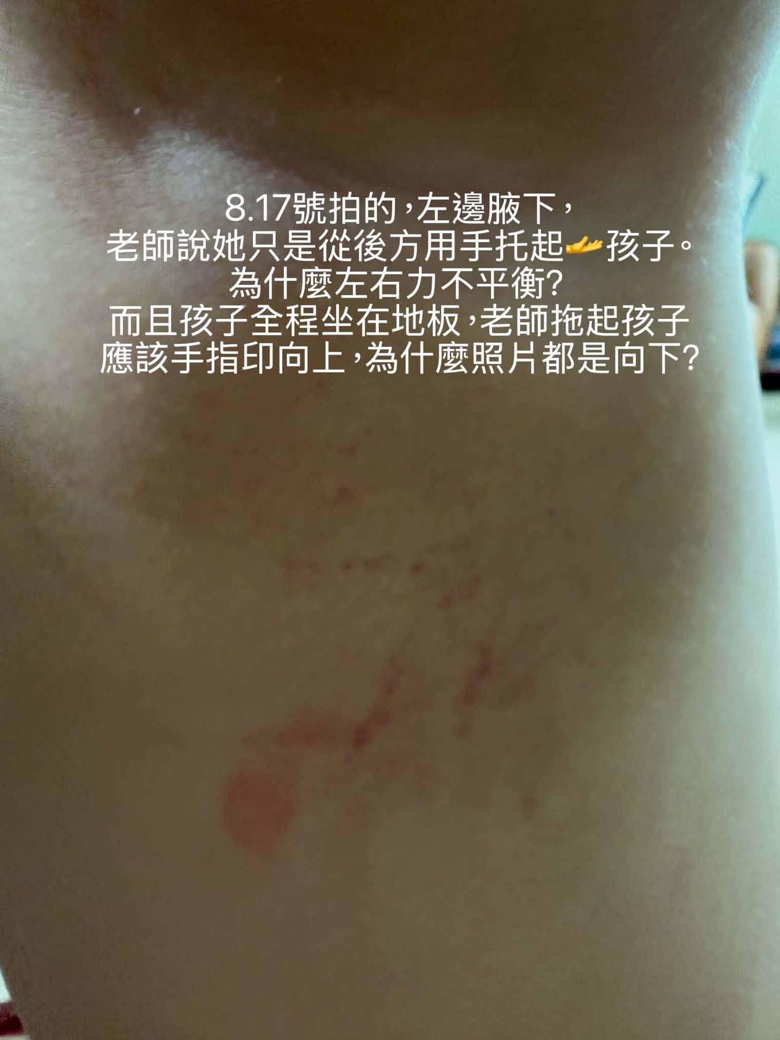 女童腋下傷勢。家屬提供