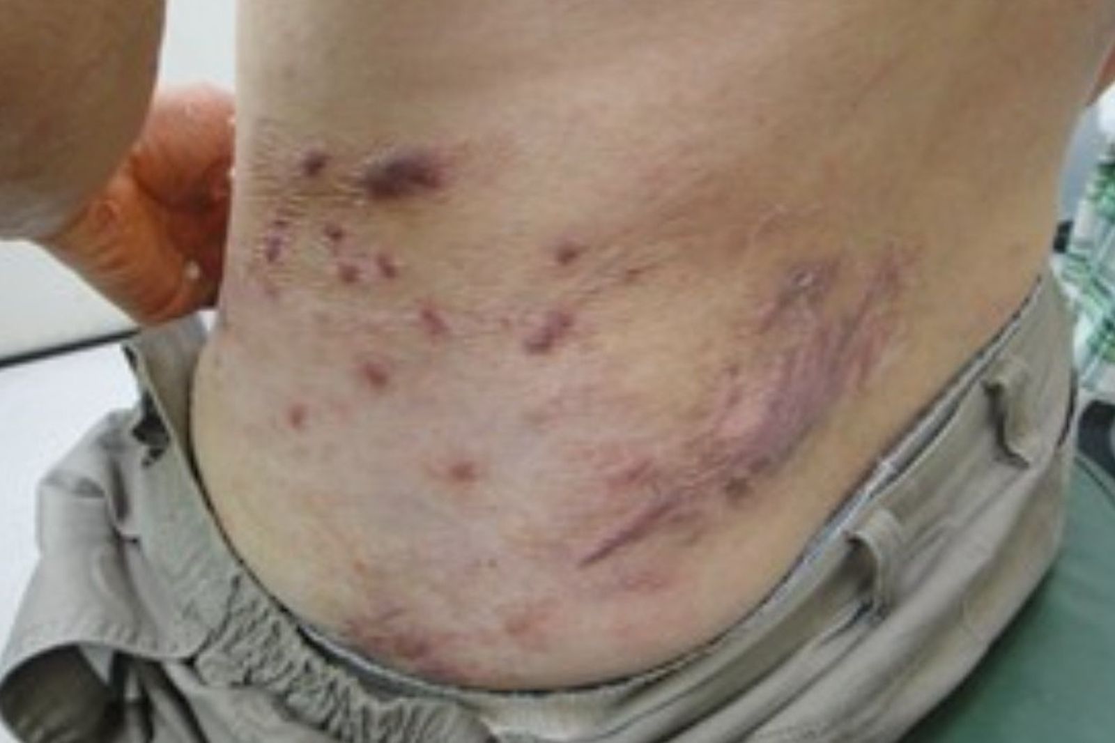 皮蛇不是繞一圈才危險！長到鼻子上恐傷眼甚至失明