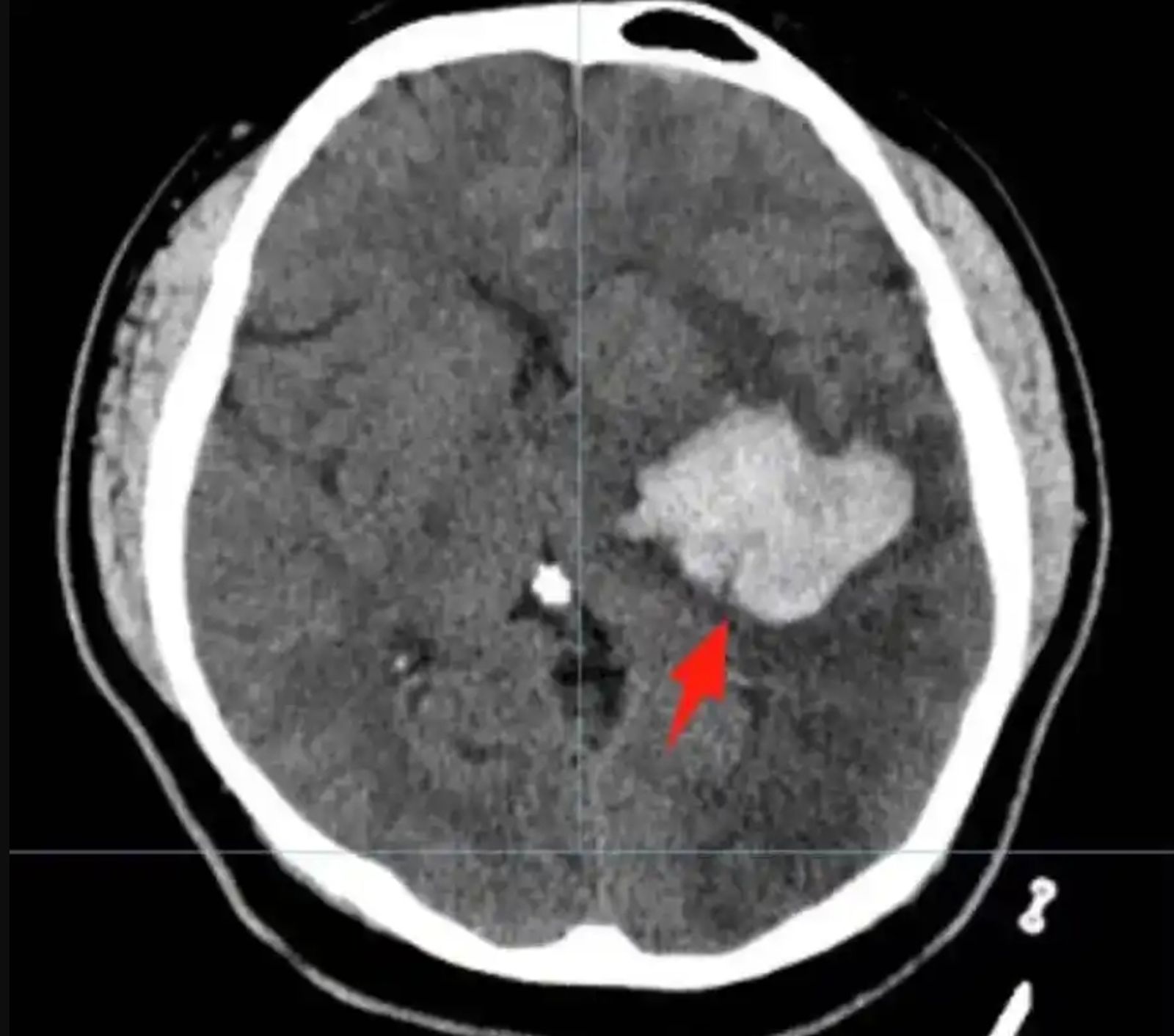 丁男腦出血。圖／翻攝羊城派