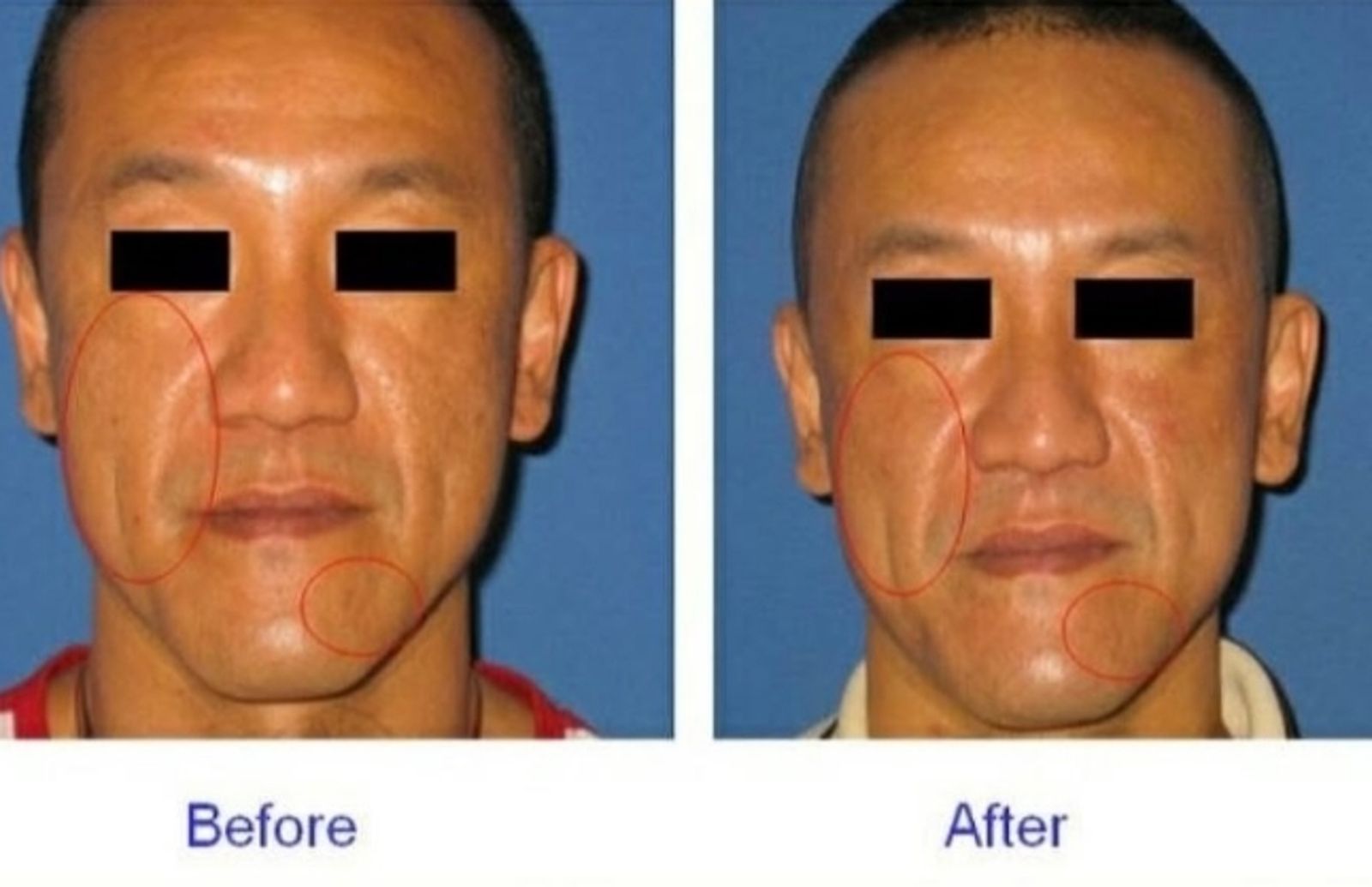 醫美廣告幫「藝人手術前後對比照打馬」！他笑翻：根本沒差…竟釣出本尊回應