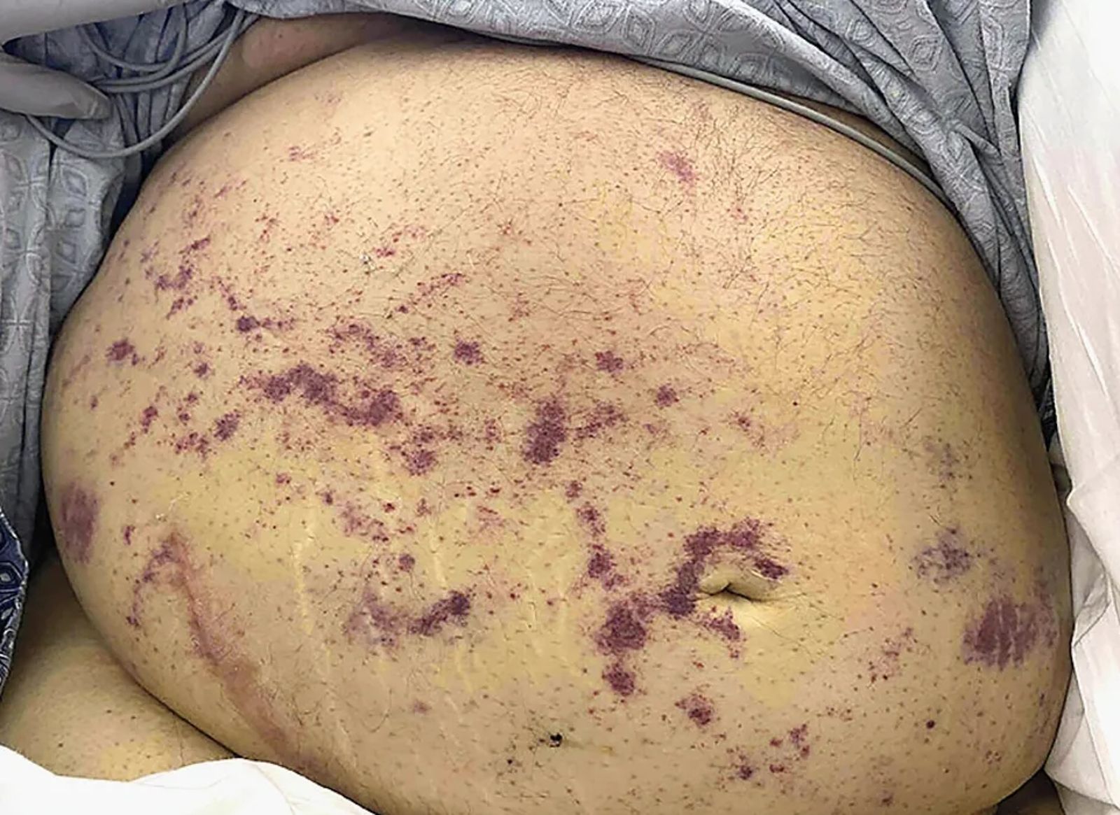 患者腹部皮膚佈滿像是瘀青一樣的紫色皮疹。圖／翻攝自新英格蘭醫學期刊