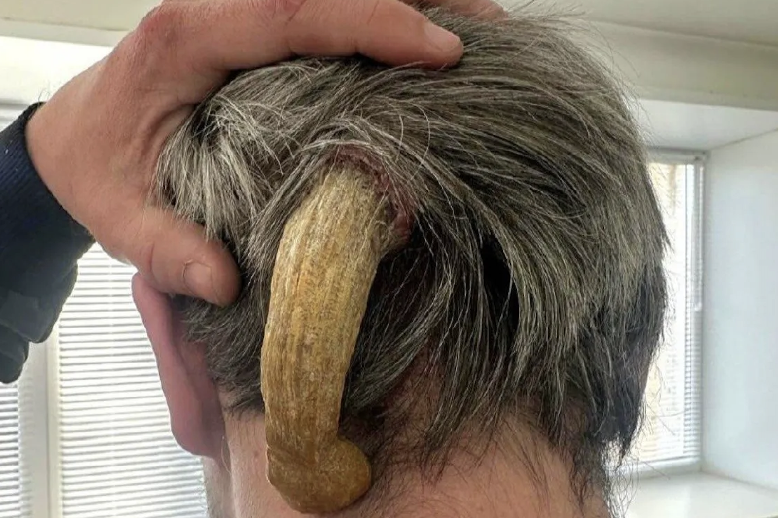 俄羅斯男子後腦勺長出巨大惡魔角。圖／翻攝自anomalien.com