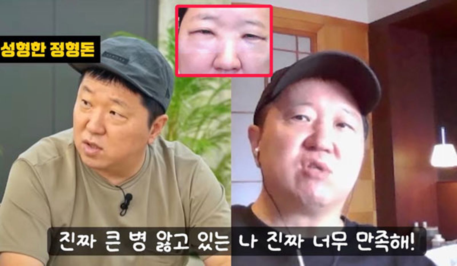 鄭亨敦分享術前的「泡泡眼」讓他看起來比較憔悴。翻攝YT@mungchintv