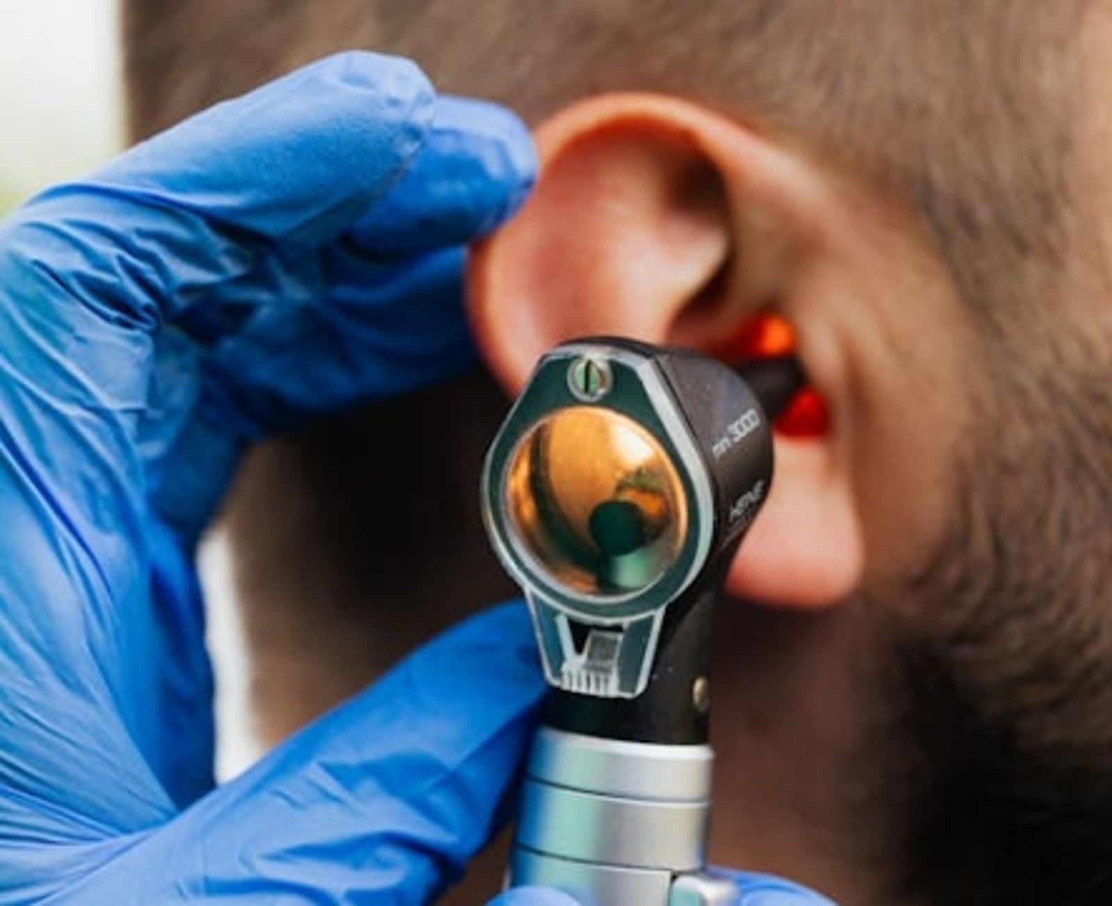 耳朵癢「自己用棉棒挖」他數天後痛到崩潰　就醫竟「取出70條蛆」超驚悚圖曝光