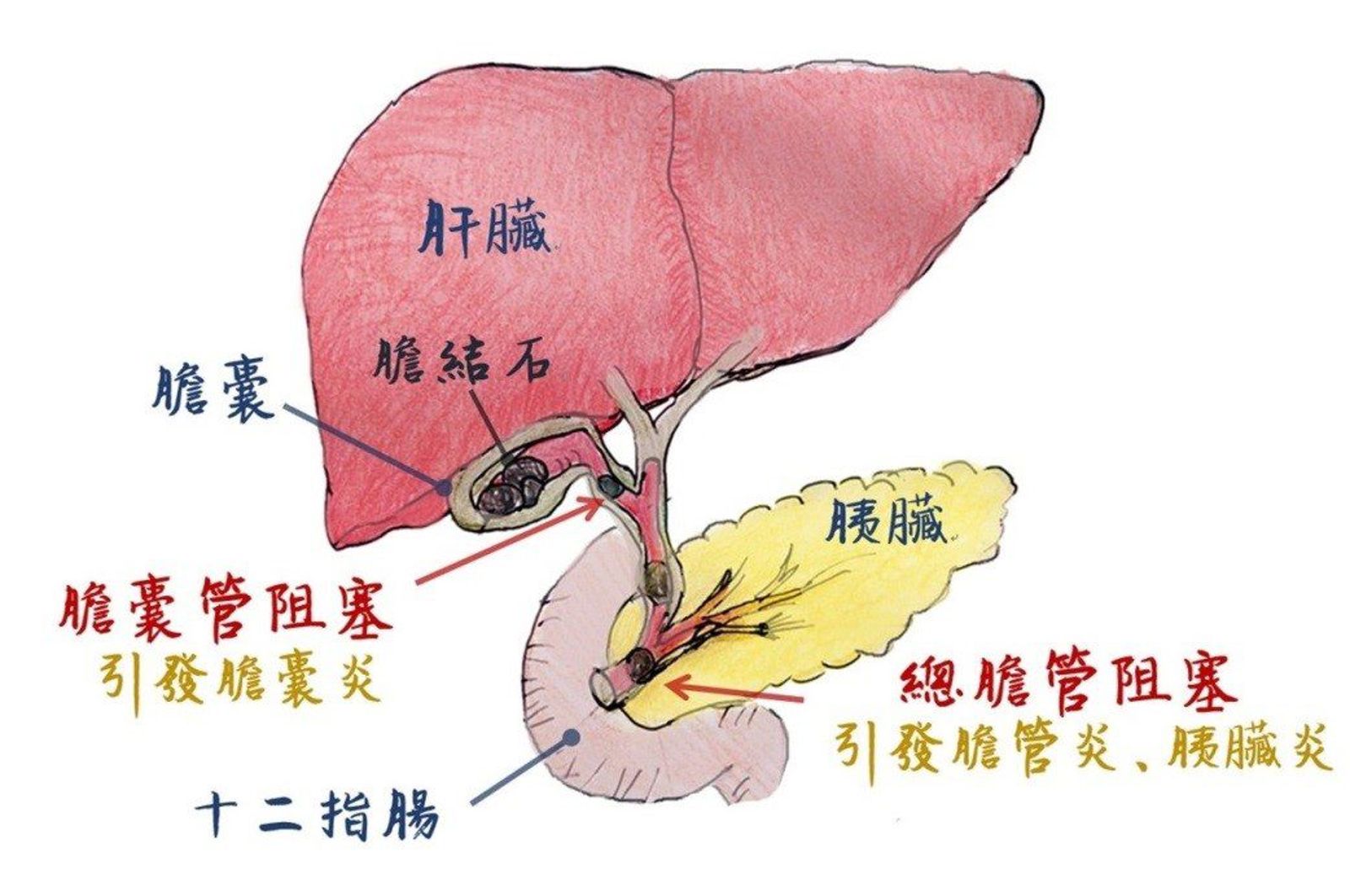 30歲男間歇斷食減肥沒成功先送醫！急性膽囊炎險奪命