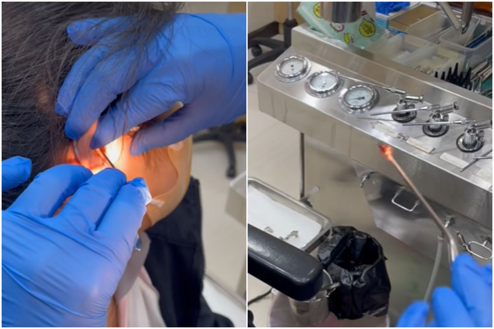 噁爛爆!少女耳朵痛 醫夾出「活生生小強」:還活蹦亂跳