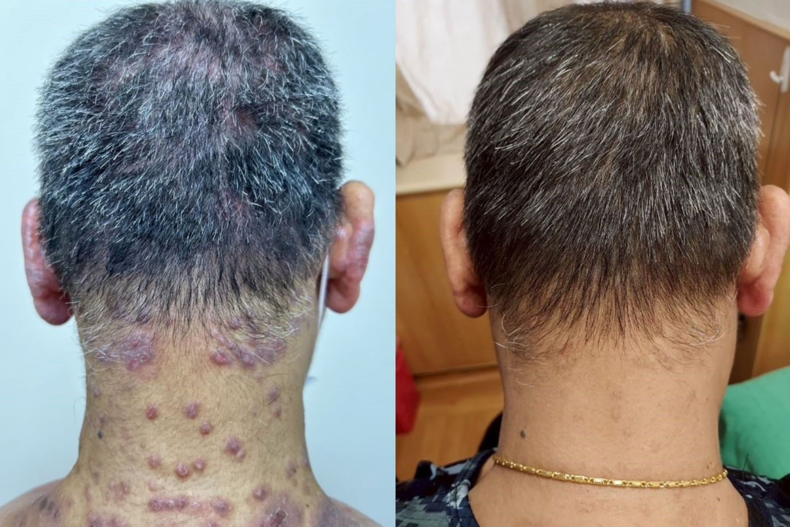 癢到睡不著、抓到潰爛！65歲男異位性皮膚炎多年難控　標靶治療4週明顯改善