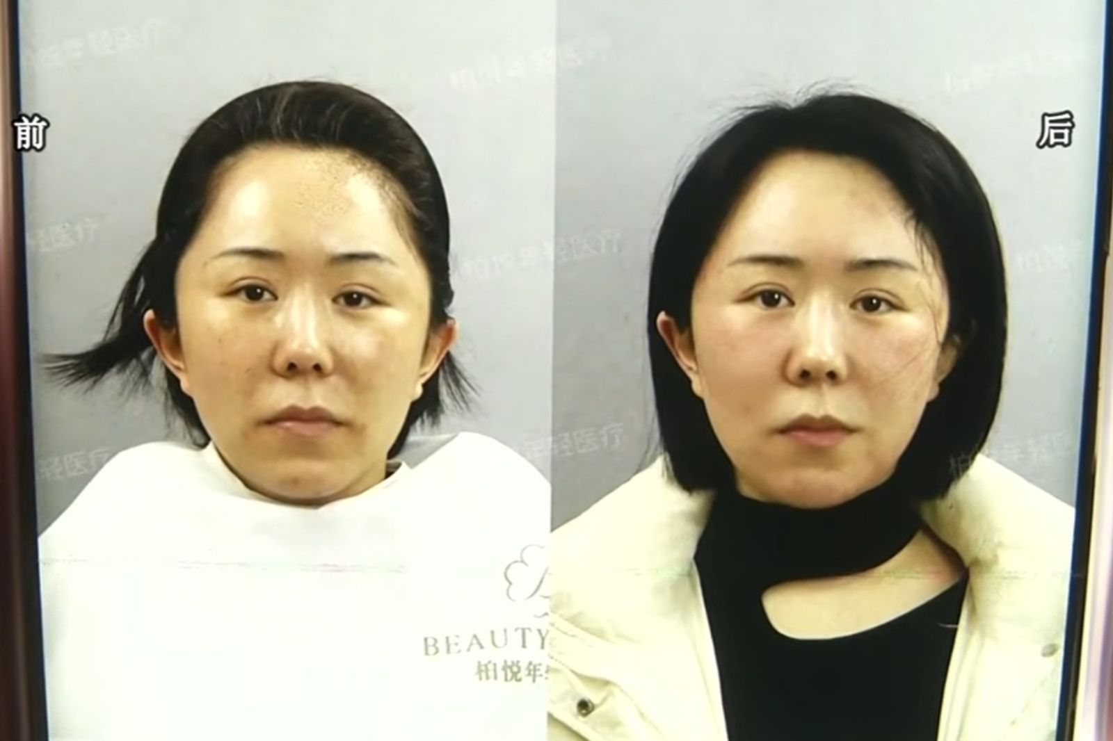 女「砸9萬醫美」做完抱怨臉垮！診所一看酸：本來就不好看