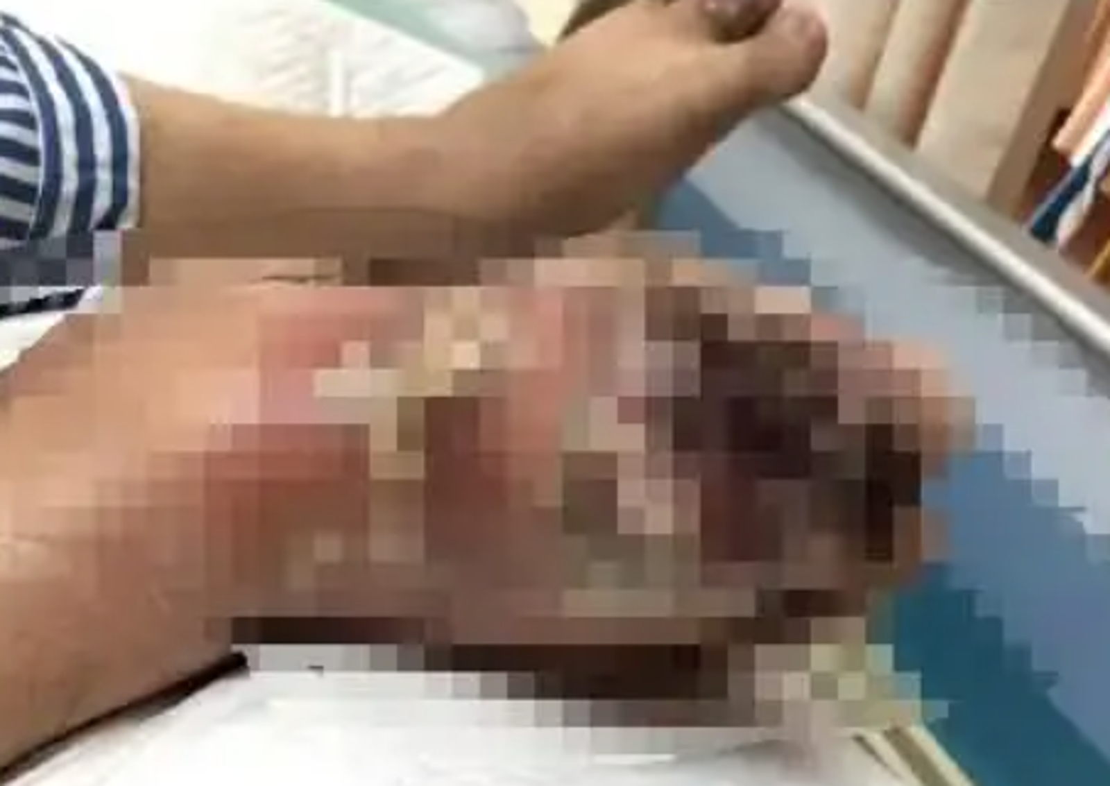 吳男右腿大面積潰爛。圖／翻攝自微博
