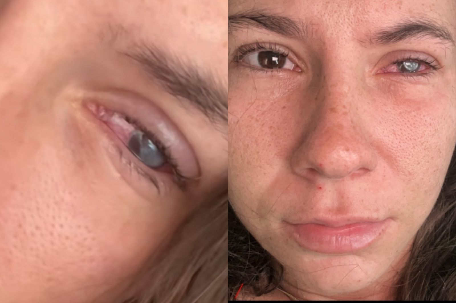 隱眼沒洗乾淨！21歲女右眼遭寄生蟲感染「角膜發灰」：痛到像拿刀子割