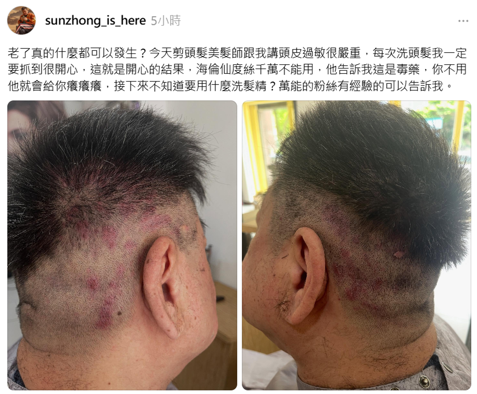 孫德榮剃頭後頭皮泛出過敏的紅色斑塊。翻攝孫德榮Threads